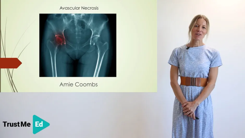 Avascular Necrosis of the Hip