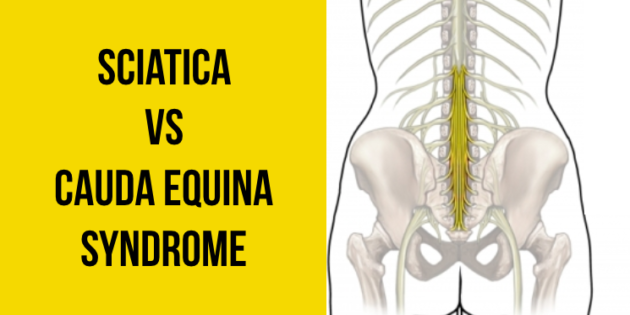 sciatica-vs-cauda-equina