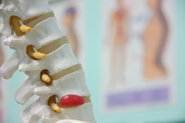 Back pain and posture