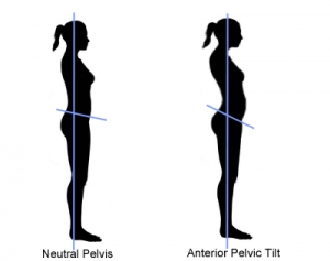 Anterior pelvic tilt