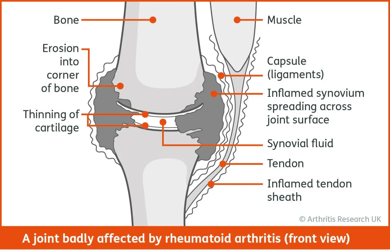 An Introduction to Rheumatoid Arthritis for Physios