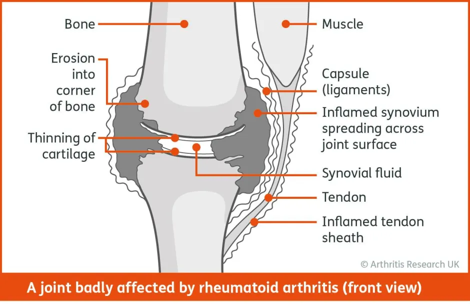 An Introduction to Rheumatoid Arthritis for Physios