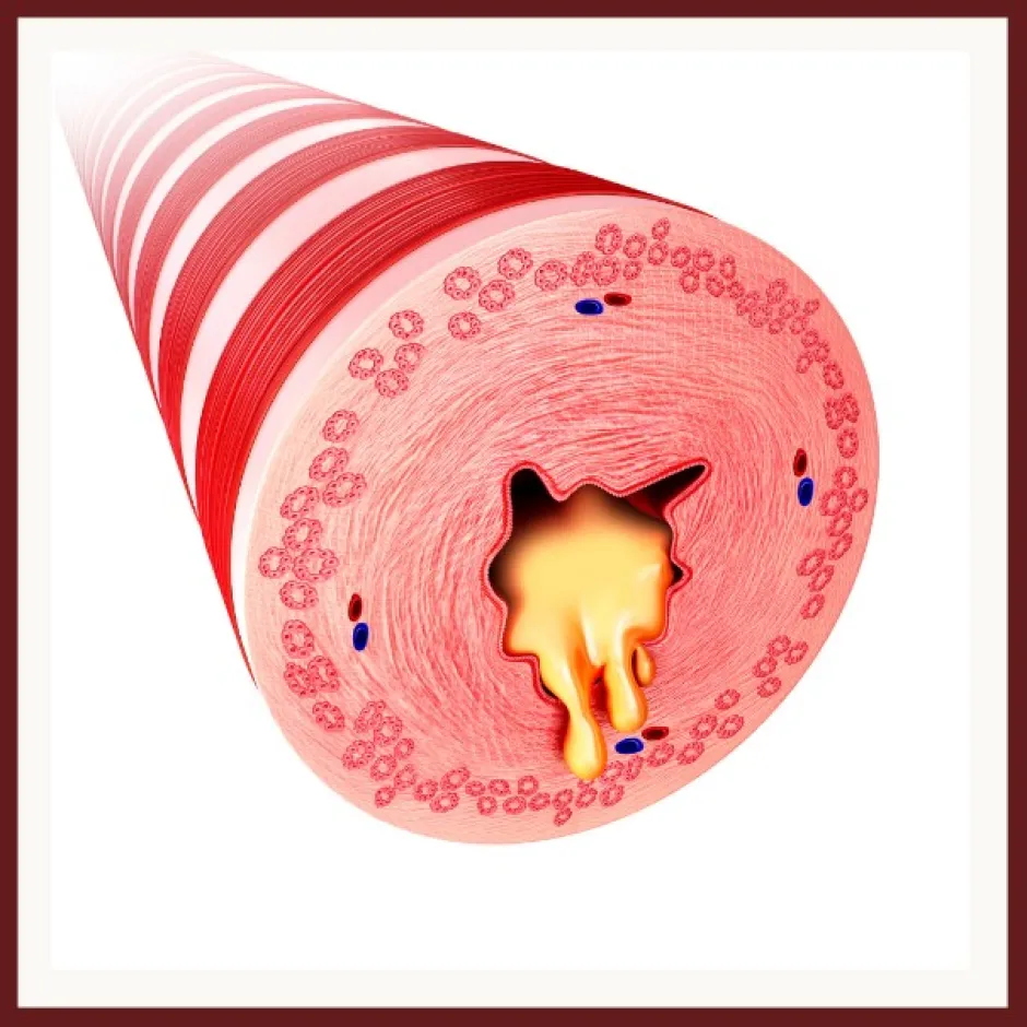THE VICIOUS CYCLE OF BRONCHIECTASIS