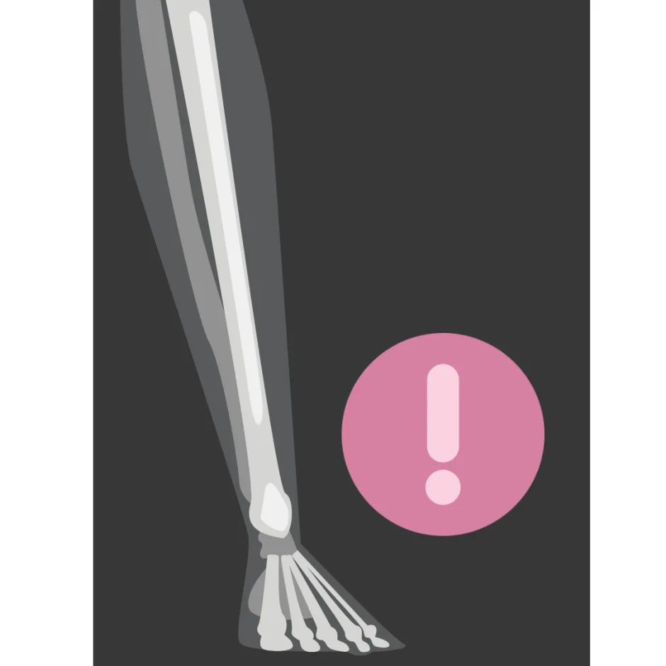 UNDERSTANDING BONE STRESS INJURIES: RISK FACTORS AND SYMPTOMS