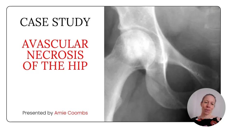 Amie Coombs - Avascular Necrosis of the Hip: Case Study