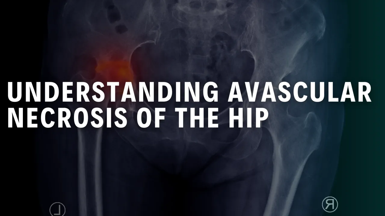 Understanding Avascular necrosis of the hip