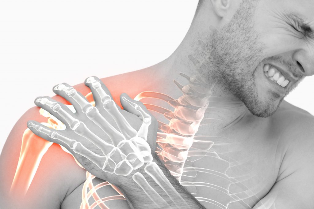 Subacromial impingement